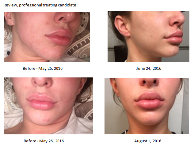 Recovery Review For Acne Neogenesis Recovery For Acne Treatment