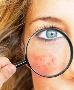 Rosacea - Living with and treating Rosacea