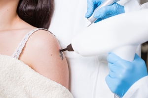 Tattoo Removal