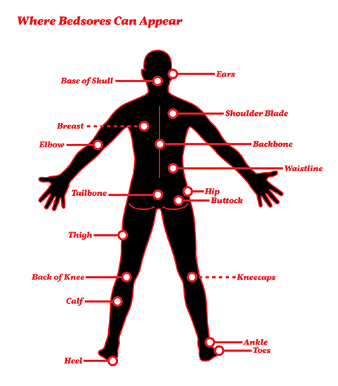 Bed Sores Pressure Sores Chronic and Traumatic Skin Conditions