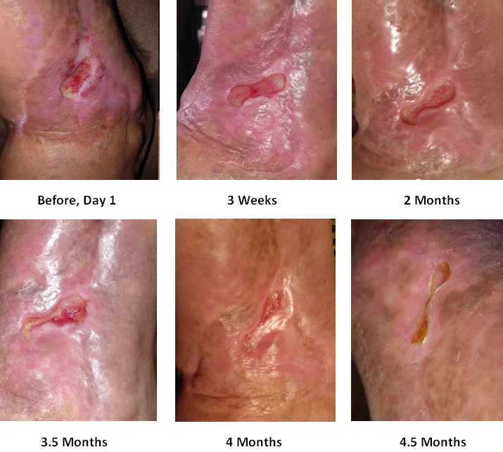 Customer Review - NeoGenesis Recovery for Wound Care