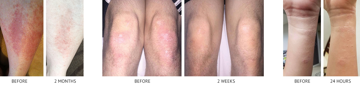 Before & After – Products for Ezcema Before & After - Products for Ezcema