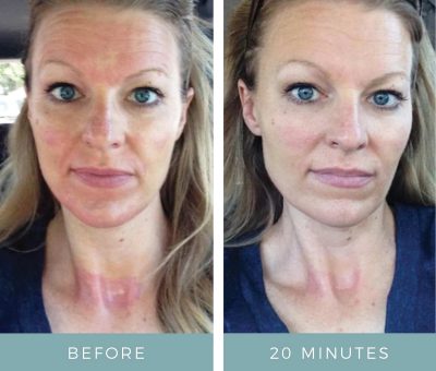 Before & After - Microneedling