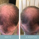 Before + After - Hair Loss