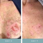 Before + After - IPL Laser Burn