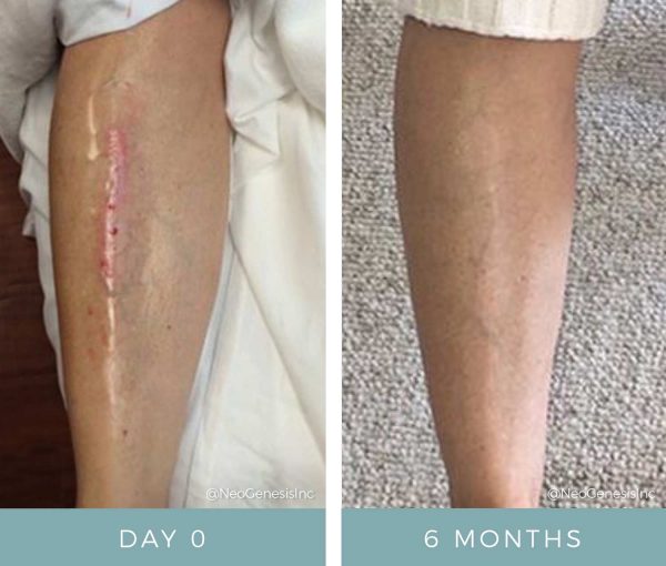 Before + After - Wound Care - Scarring