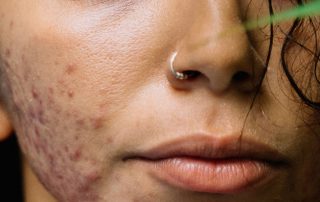 Acne Care Solutions for Your Clients