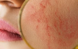 Rosacea Skincare Protocols