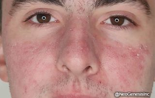 After - Acne + Contact Dermatitis