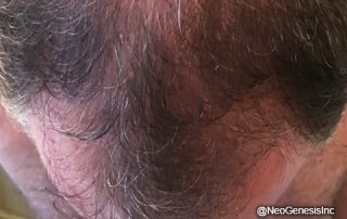 After - Hair Loss