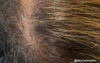 After - Hair Loss + Microneedling