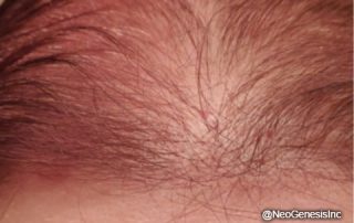 After - Hair Loss in Women