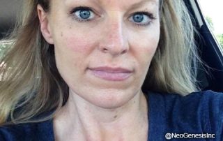 Microneedling - After NeoGenesis Skincare Products