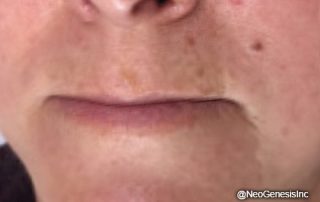 After - Rosacea + Microcurrent