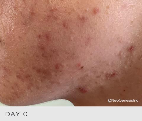 Before - Hormonal Acne Breakouts