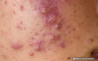 Before - Acne