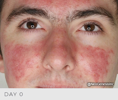 Before - Acne + Contact Dermatitis