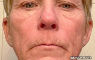 Before - Ageing Skin - Microneedling, Microcurrent, Ultrasound and NeoGenesis Products