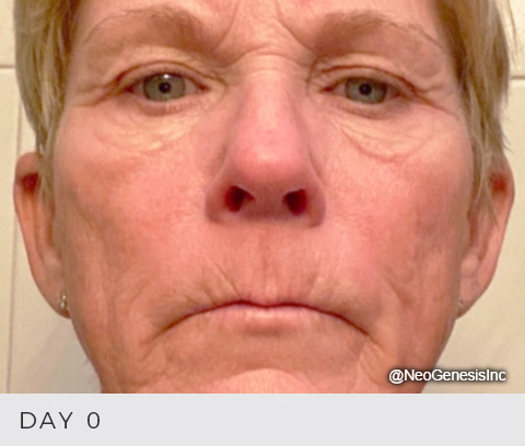 Before - Ageing Skin - Microneedling, Microcurrent, Ultrasound and NeoGenesis Products