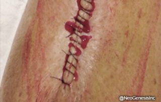 Before - Cancer Surgery Scarring