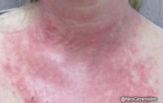 Before Recovery Serum for Chemical Peel + Radiation