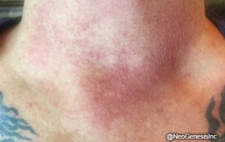 Post Chemical Peel