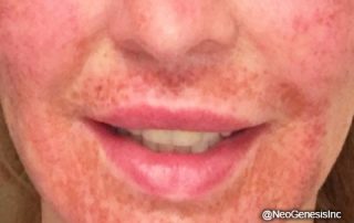 Post C02 Laser + PRP