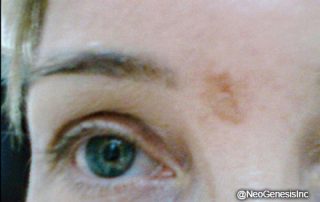 Before - Fraxel Laser Scarring