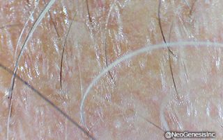Before - Hair Loss + Microneedling