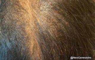 Before - Hair Loss + Microneedling