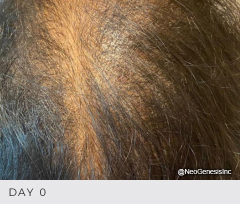 Before - Hair Loss + Microneedling