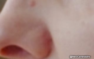 Before - Hyperkeratosis