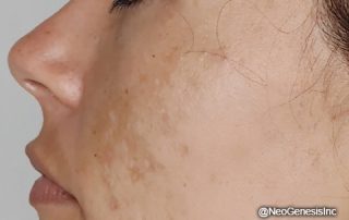 Before - Hyperpigmentation