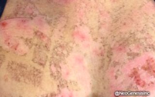 Before - IPL Laser Burns