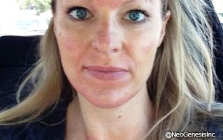 Microneedling Skin Care - Before NeoGenesis Skincare Products