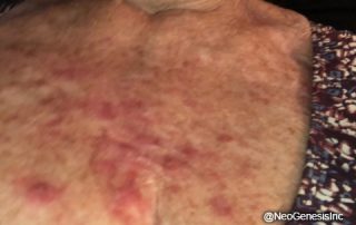 Before - Radiation Dermatitis