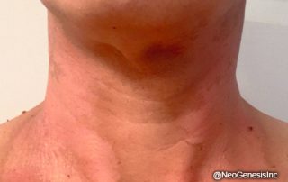 Before - Radiation - Head + Neck Cancer