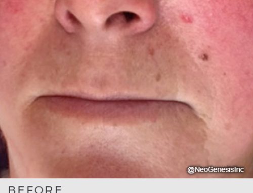 Rosacea + Microcurrent