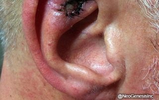Before - Mohs Surgery