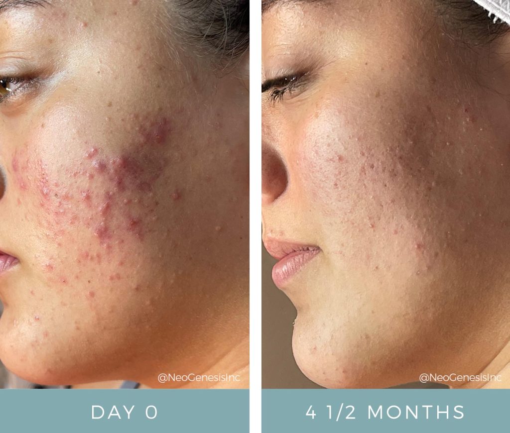 Before + After - Acne