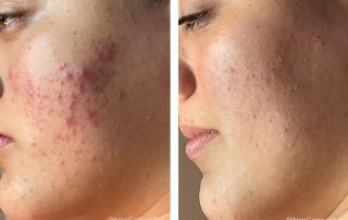 Before + After - Acne