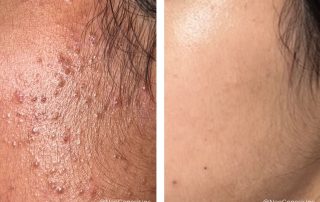 Before + After - Acne