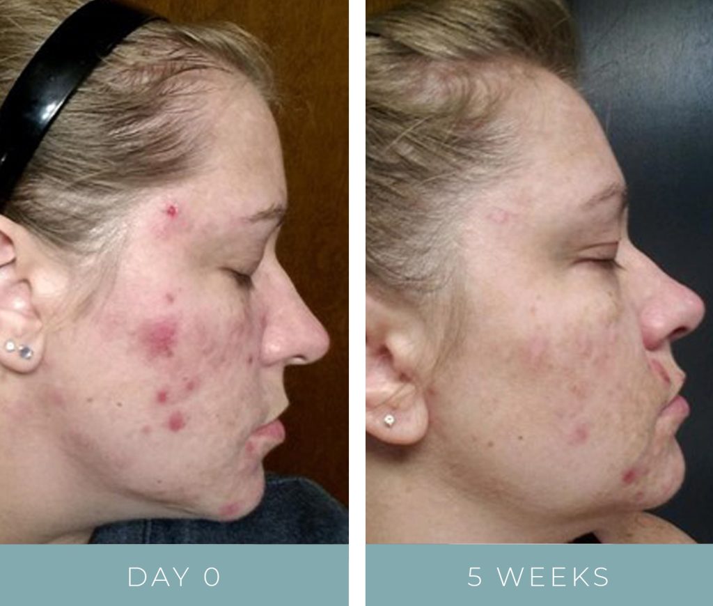 Before + After - Chronic Acne