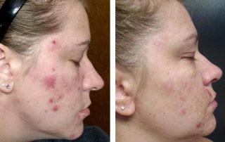 Before + After - Chronic Acne