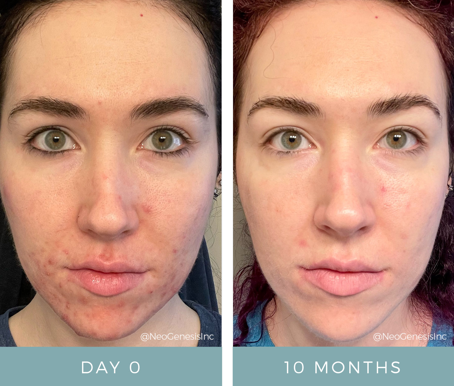 Before + After - Hormonal Acne