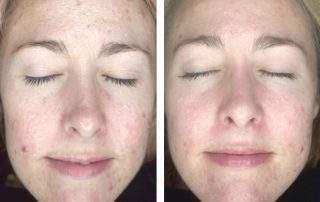 Before + After - Acne