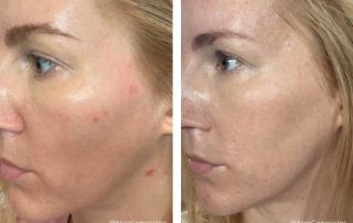 Before + After - Acne