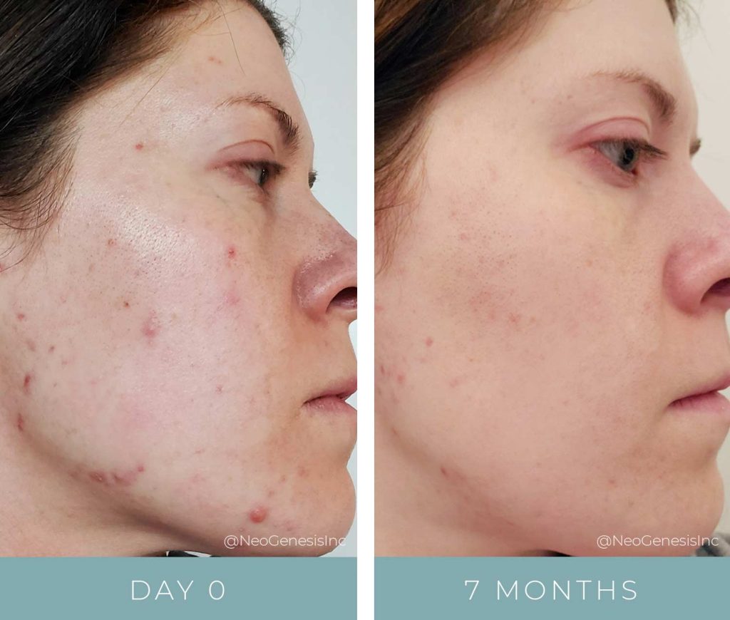 Before + After - Hormonal Acne Breakouts