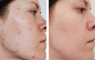 Before + After - Hormonal Acne Breakouts