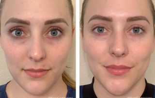 Before + After - Acne